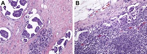 Isolated Contralateral Axillary Lymph Node Involvement In Breast Cancer
