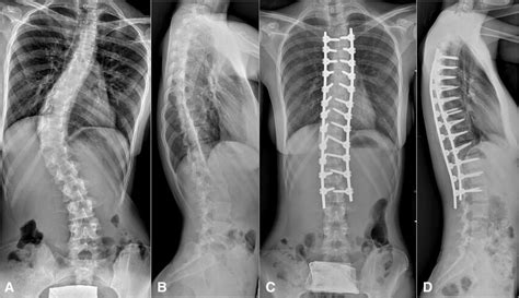 A 17 Year Old Female Patient With A Lenke 1an Scoliosis With A Main Download Scientific Diagram