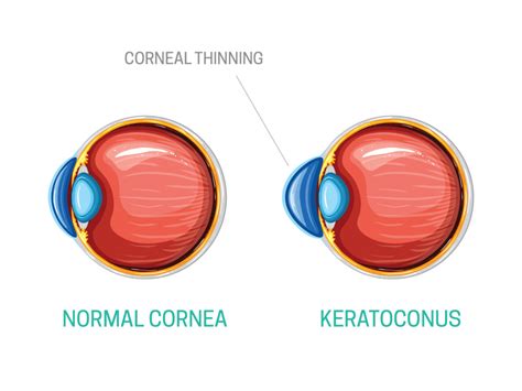 Keratoconus Symptoms Causes And Treatment Kraff Eye Institute