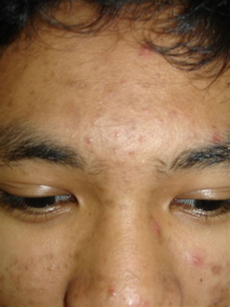 Medical Pictures Info Acne Cyst