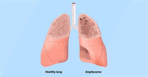 Lungs With Emphysema