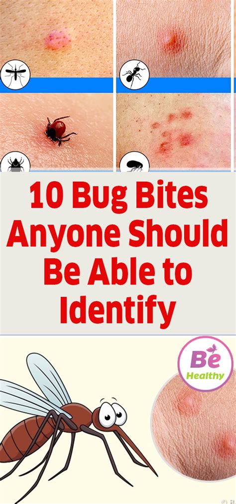 Insect Bite Identification Guide My Xxx Hot Girl