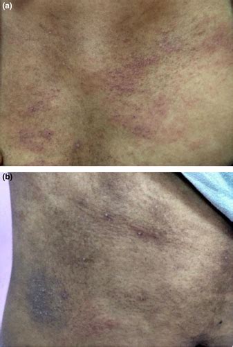 Persistent Pruritic Rash Fever And Joint Pains In A Young Female