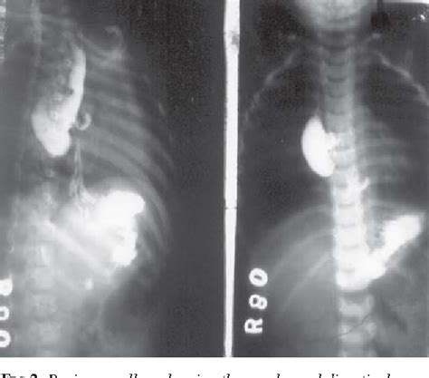 Figure 2 From Esophageal Diverticulum Secondary To Impacted Foreign