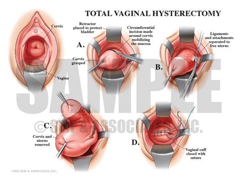 Vaginal Hysterectomy Female Reproductive System Pinterest