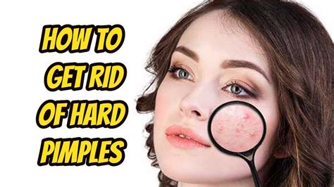 How To Get Rid Of Hard Pimples Hard Pimple Under Skin Youtube