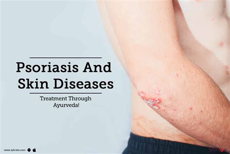 Psoriasis And Skin Diseases Treatment Through Ayurveda By Dr