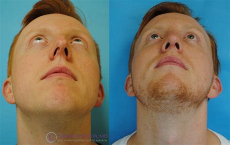 This Is A 3 Month Before And After Rhinoplasty Result Showing A Deprojected But Masculine Nose