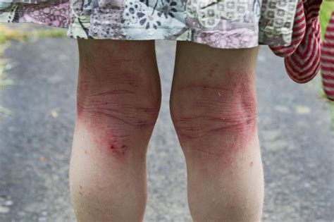 Eczema Rash On Inner Thigh