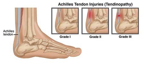 Physical Therapists Guide To Achilles Tendon Injuries Tendinopathy