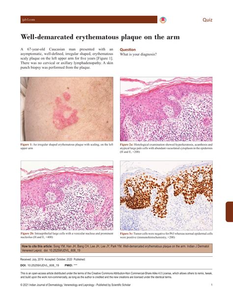 Pdf Well Demarcated Erythematous Plaque On The Arm