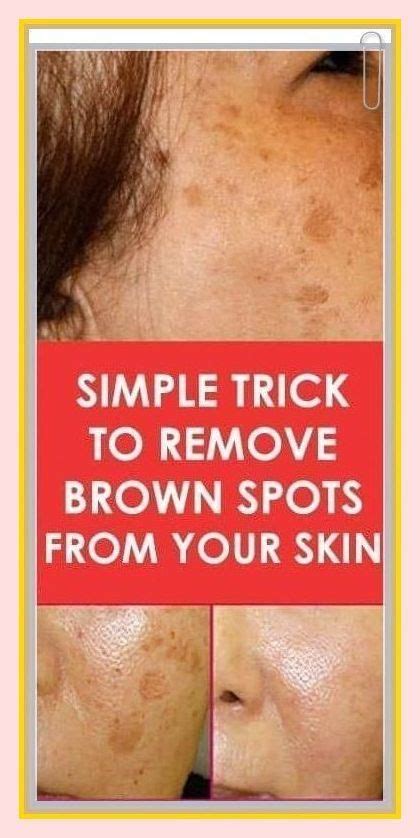 Simple Trick To Remove Brown Spots From Your Skin In Brown Spots