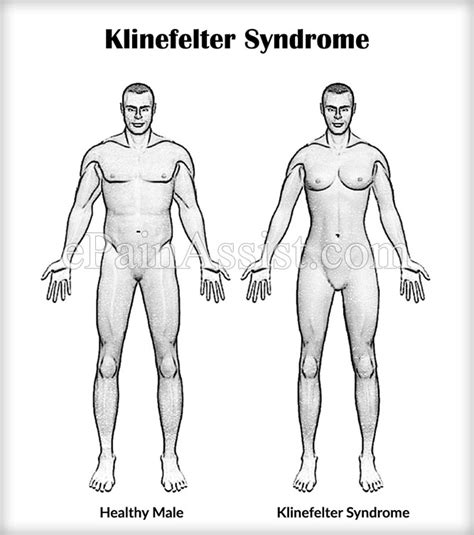 klinefelter syndrome causes symptoms treatment diagnosis