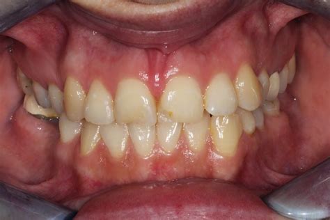 Missing Back Teeth Before And After Pictures