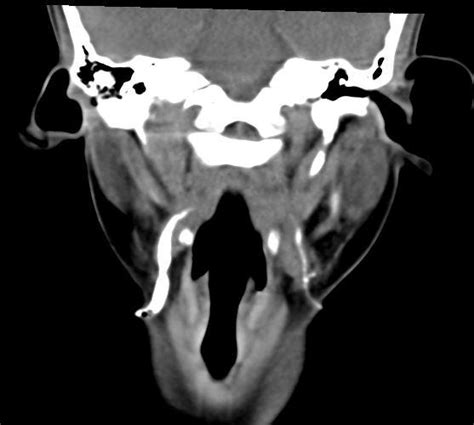 A Case Of Bilateral Second Branchial Cleft Fistula Eurorad