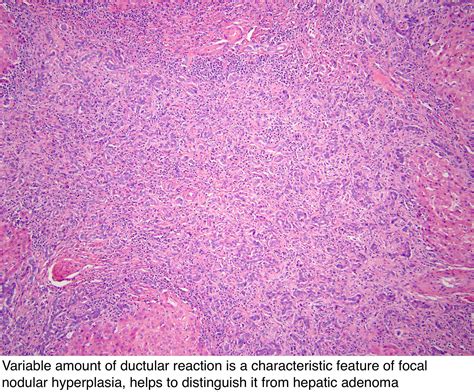 Pathology Outlines Focal Nodular Hyperplasia