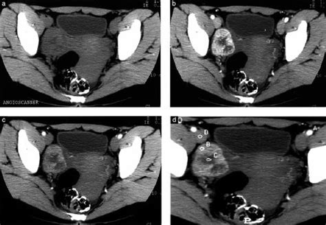 Sclerosing Stromal Tumor Of The Ovary Color Doppler Findings Deval