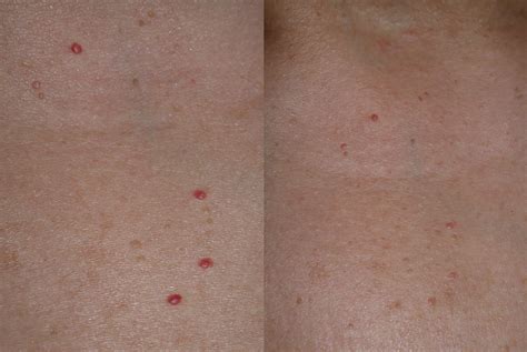 Cherry Angioma Pictures Cherry Angiomas Finesse Skin Clinic In