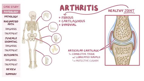 Rheumatoid Arthritis And Osteoarthritis Pathology Review Osmosis