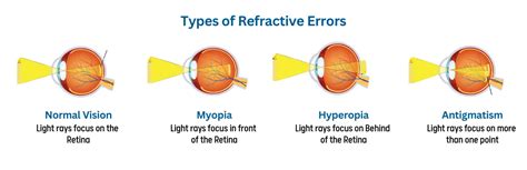 Refractive Errors Types Symptom And Refractive Surgeries