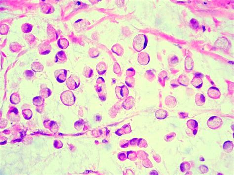 Signet Ring Cells From A Case Of Adenocarcinoma Of The Pro Flickr