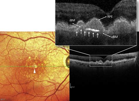 appearance of regressing drusen on optical coherence tomography in age related macular