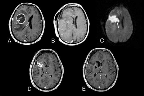 Ct Scan Brain Tumor Study Shows Certain Brain Tumors May Run In