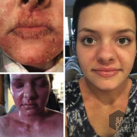 Amazing Eczema Before And Afters Salts Of The Earth