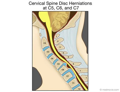 Cervical Spine Disc Herniations At C5 C6 And C7