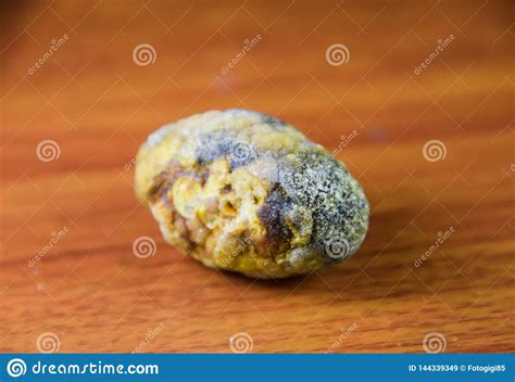 Large Gallstone Gall Bladder Stone The Result Of Gallstones Stock