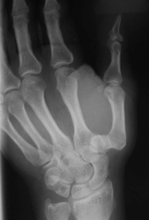 Isolated Thumb Carpometacarpal Joint Dislocation A Case Report And