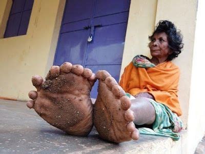 Phool Aur Kankar Indian Woman Has Toes And Fingers Setting Wo Poor Family Fingers