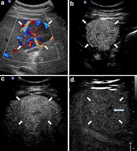 Contrast Enhanced Ultrasound In Combination With Color Doppler