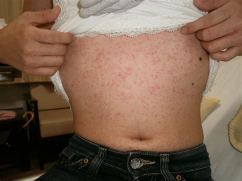 Skin Rash In A Patient With Infectious Mononucleosis Bmj Case Reports