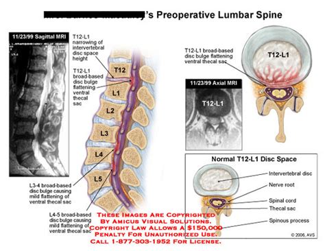 Preoperative Lumbar Spine