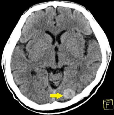 A Contrast Enhanced Cranial Ct Scan Showing A 20×17×16 Cm Hyperdense