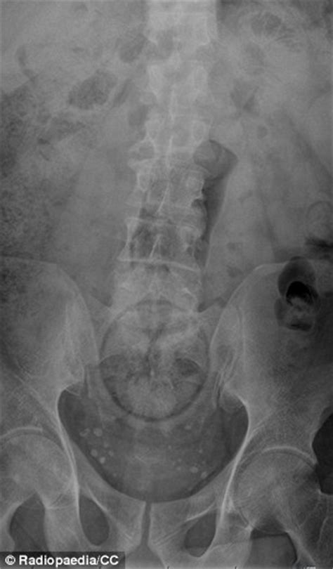 Doctors Share X Rays Of The Strangest Things Theyve Found Stuck In Peoples Rears Daily Mail
