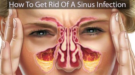 Account Suspended Sinus Infection Remedies Sinus Infection Sinusitis