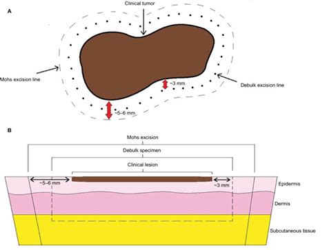 Schematic Of Mohs Micrographic Surgical Excision For Melanoma A