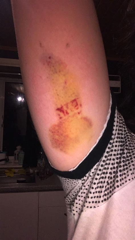 Dundee Mum Left With Huge Willy Shaped Bruise After Contraceptive