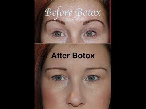 Botox Gone Wrong Hooded Eyes Check This Out Scary Botox Droopy Eyes Botox Before And After