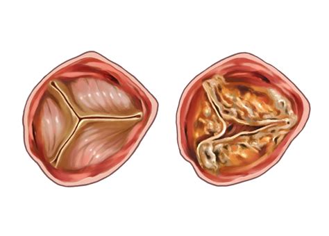 Mitral Kapak Cerrahisi Akut Kalp Damar Hastanesİ