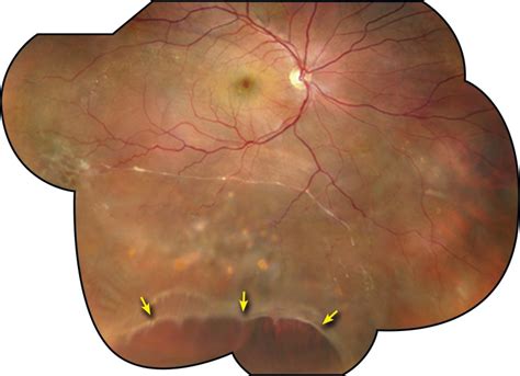 Operculated Retinal Hole In Retinal Detachment Retina