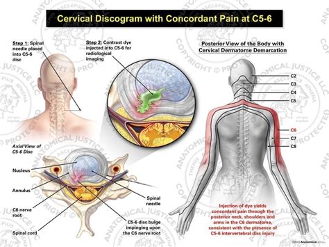 Cervical Spine Compression Hisaframe