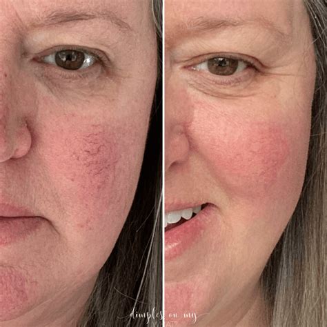 My Experience With Laser Treatment For Rosacea Including Before And After