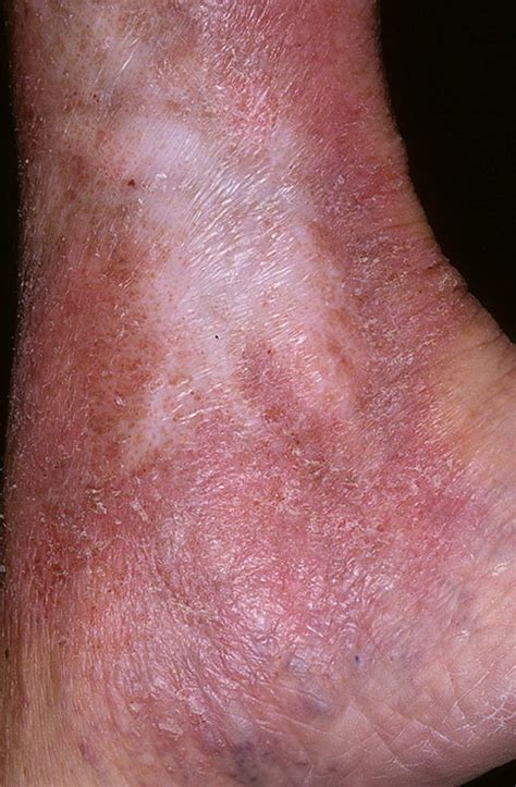 Stasis Dermatitis Pictures Photos Images Illnessee Com