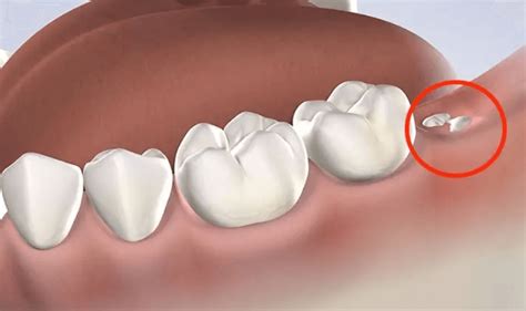 Những lợi ích thay răng hàm mà bạn không thể bỏ qua