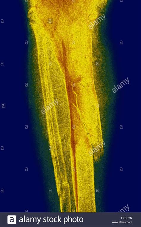 Fractured Leg X Ray Stock Photo Alamy