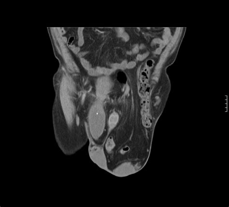 Inguinoscrotal Bladder Hernia Radrounds Radiology Network
