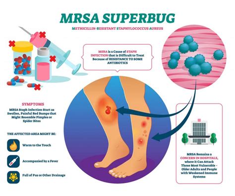 Mrsa In Children Causes And Treatment By Dr Srikanta J T Being The
